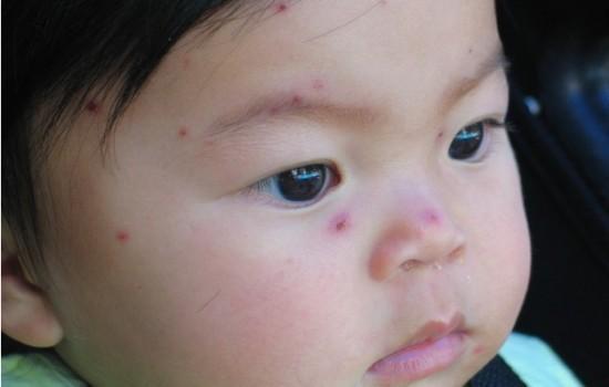 水痘可以吃瓜嘛,瓜类食物的适宜与否